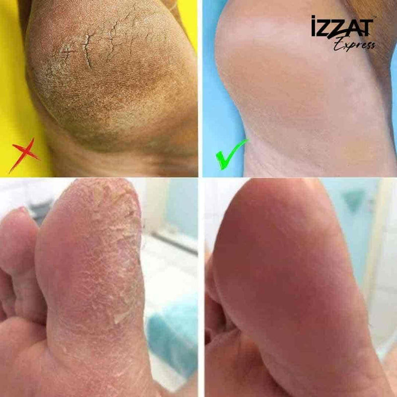 Lixa Elétrica Para os Pés Callus Soft™ - Removedor de Calos e Rachaduras